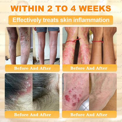 NEW & IMPROVED ✨Bellelala® 𝖡𝖾𝖾 𝗏𝖾𝗇𝗈𝗆 𝖲𝗄𝗂𝗇 𝖱𝖾𝗌𝗍𝗈𝗋𝖺𝗍𝗂𝗈𝗇 𝖢𝗋𝖾𝖺𝗆