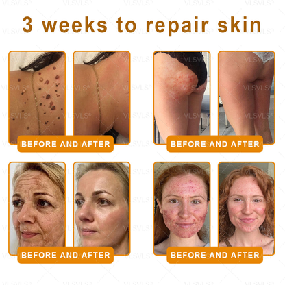 Made and Shipped from USA ✨ VLSVLS® Bee Venom Skin Restoration Cream 🌸 Anti-aging,Hydrating, Skin Repair, Even Tone, Acne and Dark Spot Treatment, Wart and Mole Removal, Psoriasis Relief CS 🔥 LAST DAY 80% OFF 💎